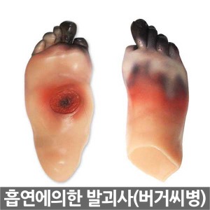 [SY] 흡연에의한 발괴사(버거씨병) M27031KO 흡연자의 발