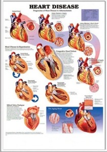 3D해부도(벽걸이)/9912 /심장질병( HEART DISEASE )/ 54cm ⅹ 74cm