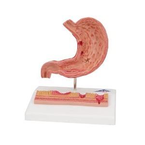 [3B] 위궤양모형 K17(14x10x17cm/0.31kg) ▶ Stomach with Ulcers 위단면모형 위염모형 궤양모형 위모형