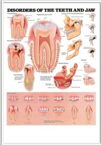 3D해부도(벽걸이)/ 9866M/치과챠트/( DISORDERS OF THE TEETH AND JAW )/47cm ⅹ 65cm
