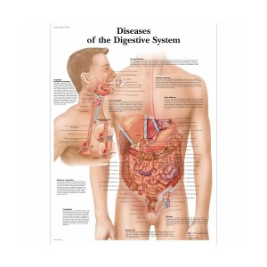 [독일3B] 소화기 질환차트 VR1431L(코팅) Diseases of the Digestive System Chart