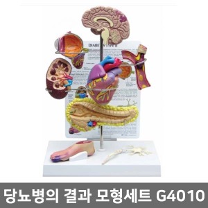 G4010 당뇨병의결과 모형세트 ▶당뇨모형세트 당뇨병