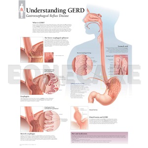 평면해부도(벽걸이) / 1550 /위식도 역류질환 Understanding GERD
