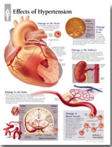 평면해부도(벽걸이)/1451 /고혈압 effects of Hypertension