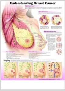 3D해부도(벽걸이)/ 9758B/유 방암의 이해 Understanding Breast Cancer/ 54cm ⅹ 74cm