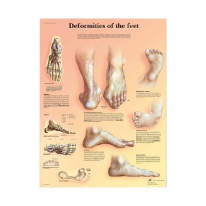 [독일3B] 발 기형차트 VR1185L(코팅) Deformities of the Feet Chart